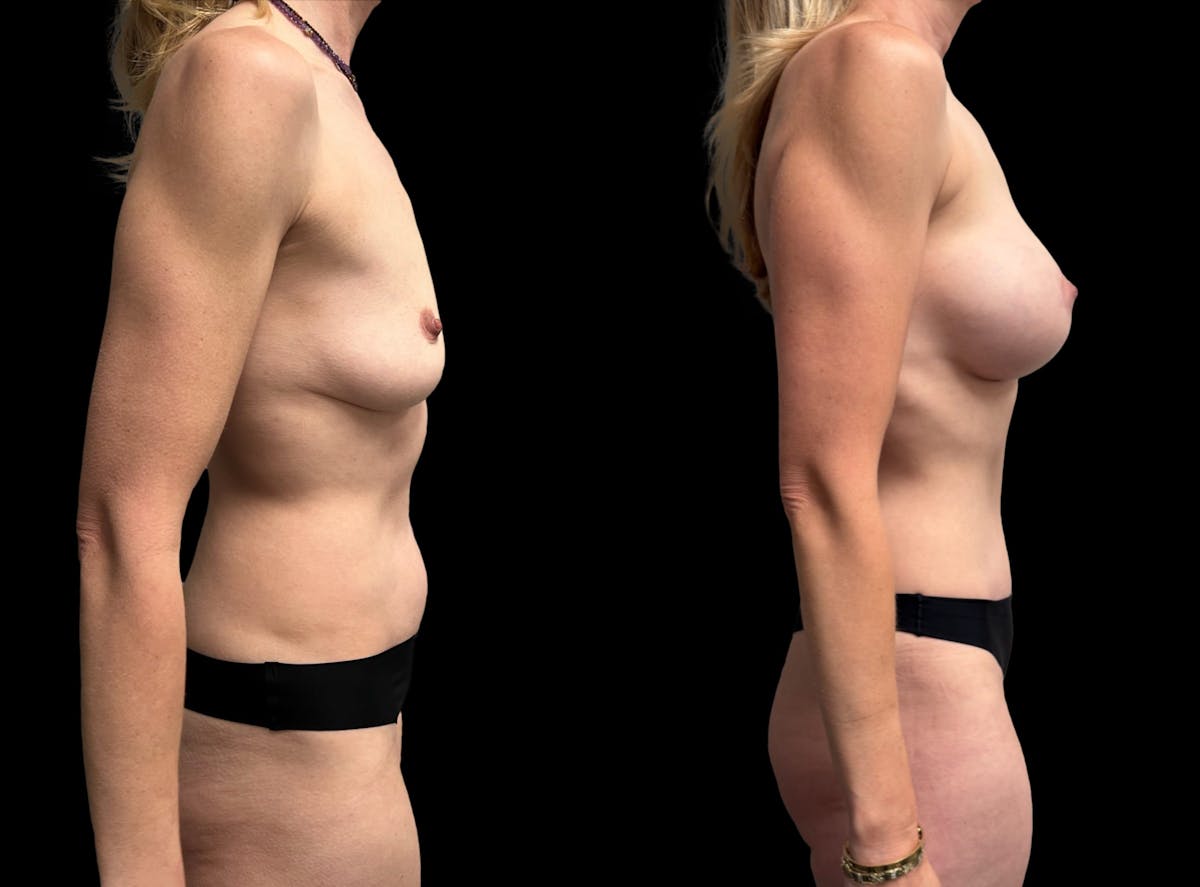 Mommy Makeover Before & After Gallery - Patient 218240 - Image 3