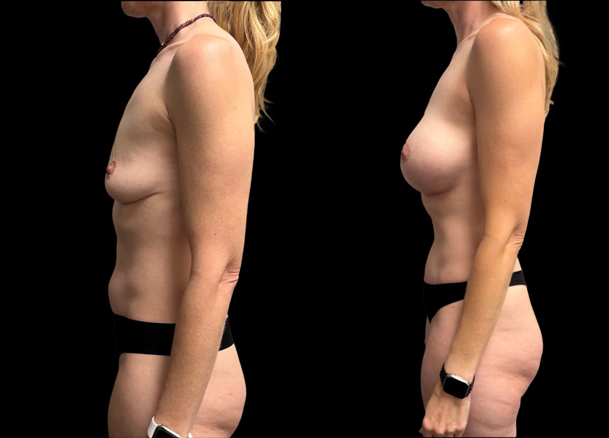 Mommy Makeover Before & After Gallery - Patient 218240 - Image 4