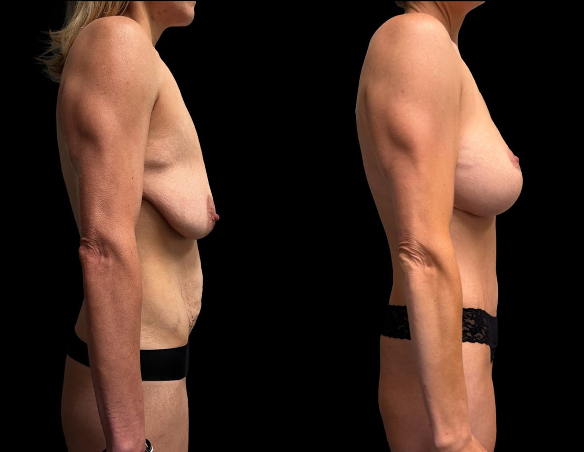 Mommy Makeover Before & After Gallery - Patient 355742 - Image 2