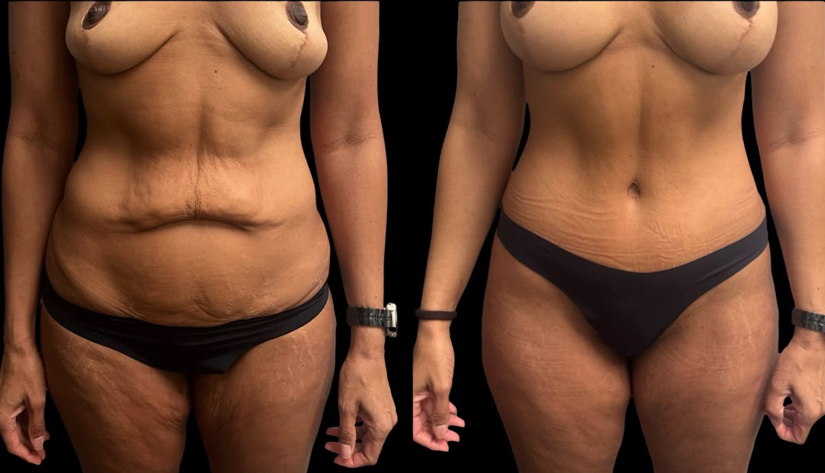 Mommy Makeover Before & After Gallery - Patient 344109 - Image 2