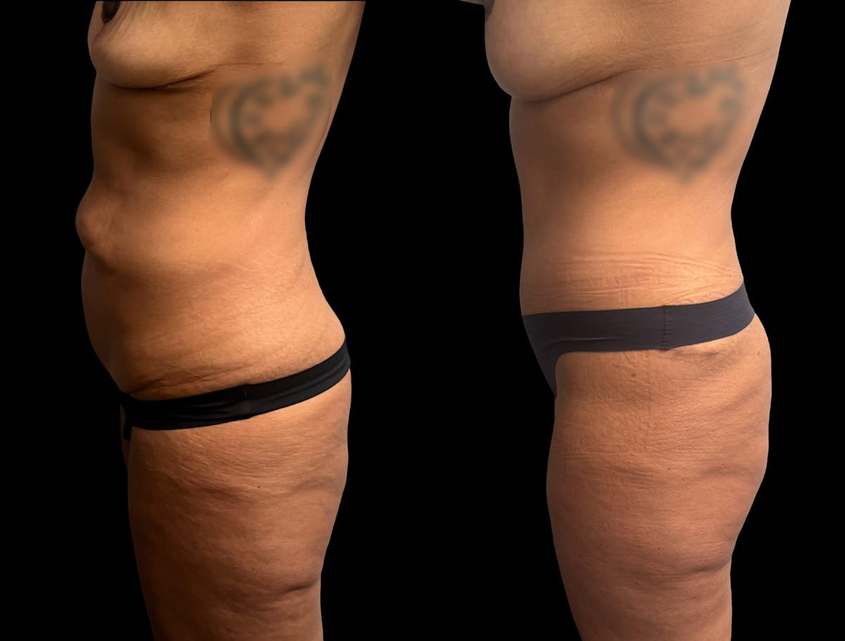 Mommy Makeover Before & After Gallery - Patient 344109 - Image 3