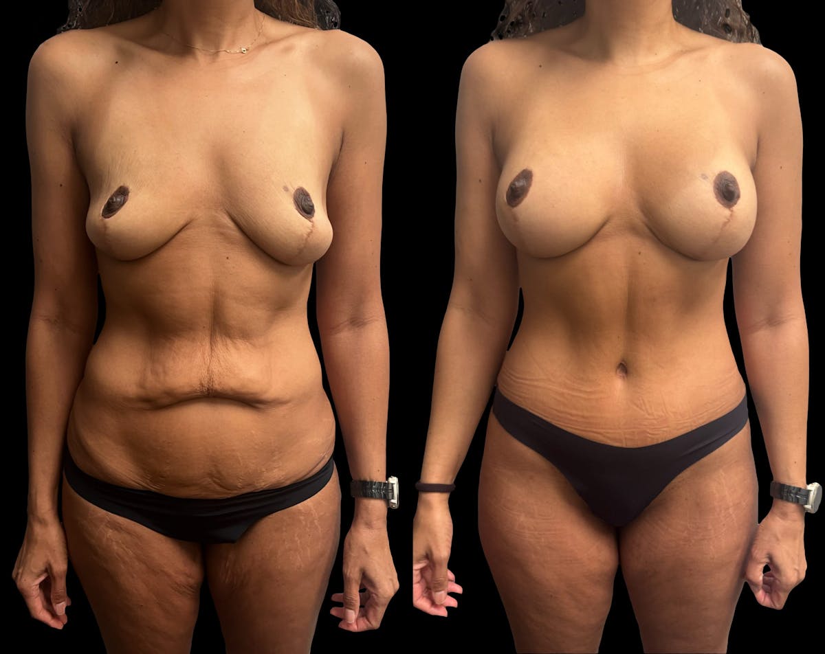 Mommy Makeover Before & After Gallery - Patient 344109 - Image 4