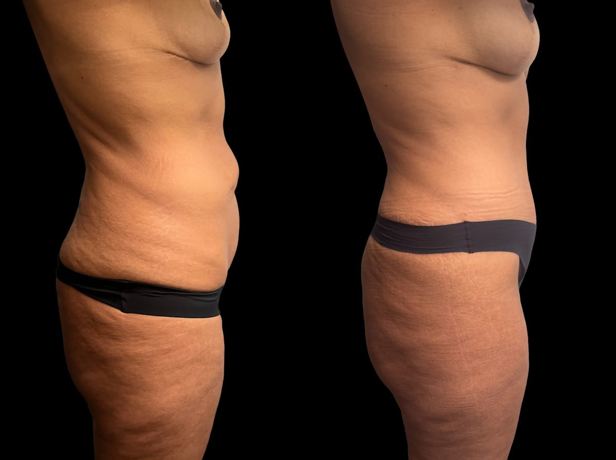 Mommy Makeover Before & After Gallery - Patient 344109 - Image 5