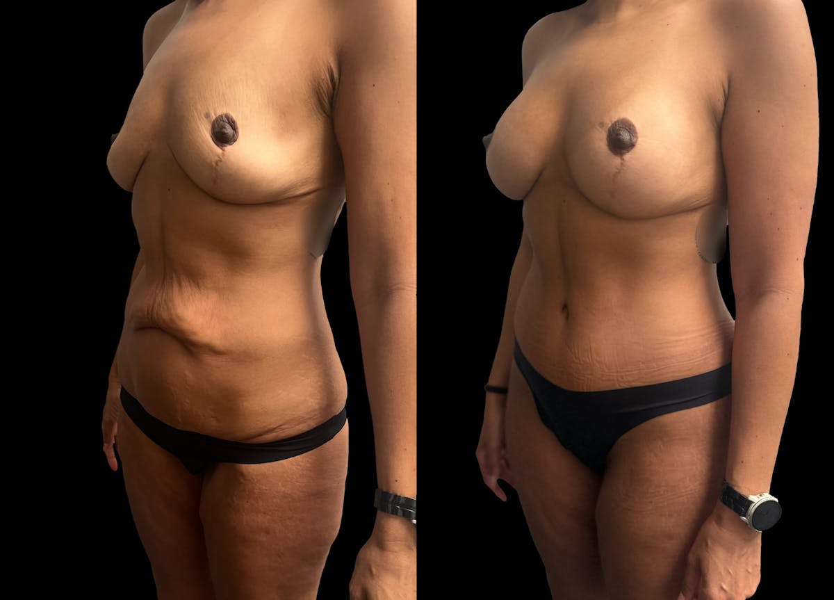Mommy Makeover Before & After Gallery - Patient 344109 - Image 1