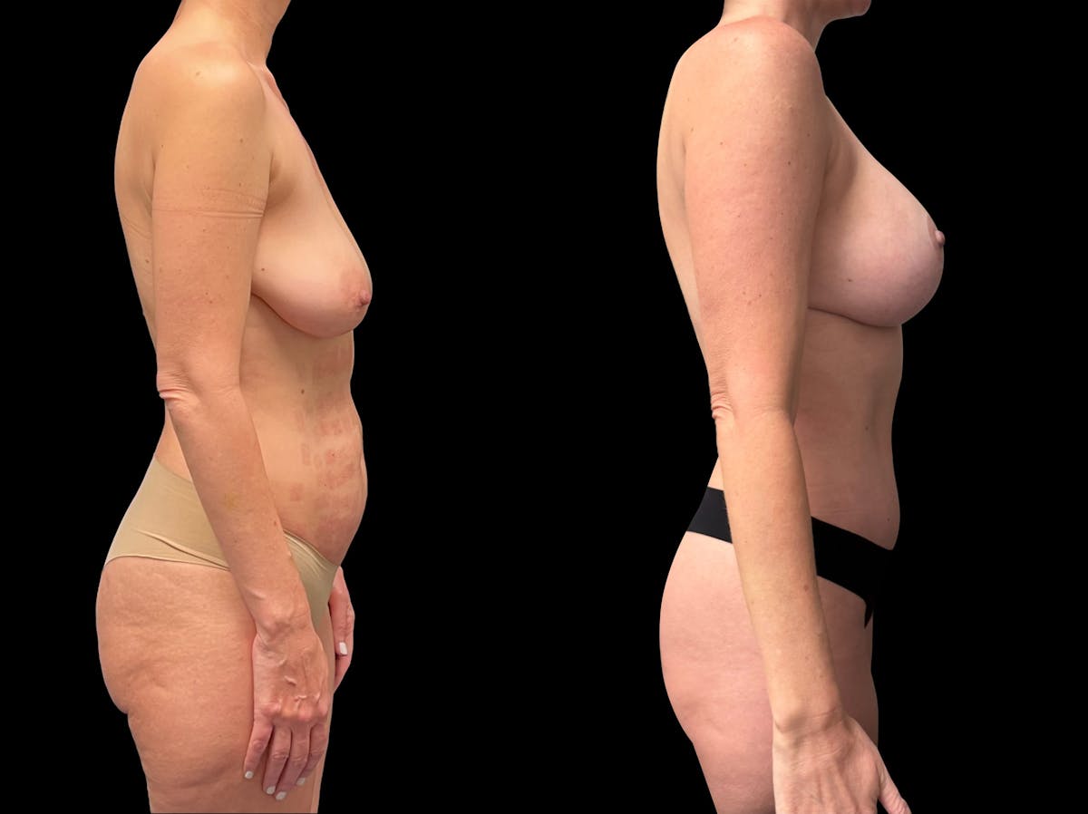 Mommy Makeover Before & After Gallery - Patient 411663 - Image 2