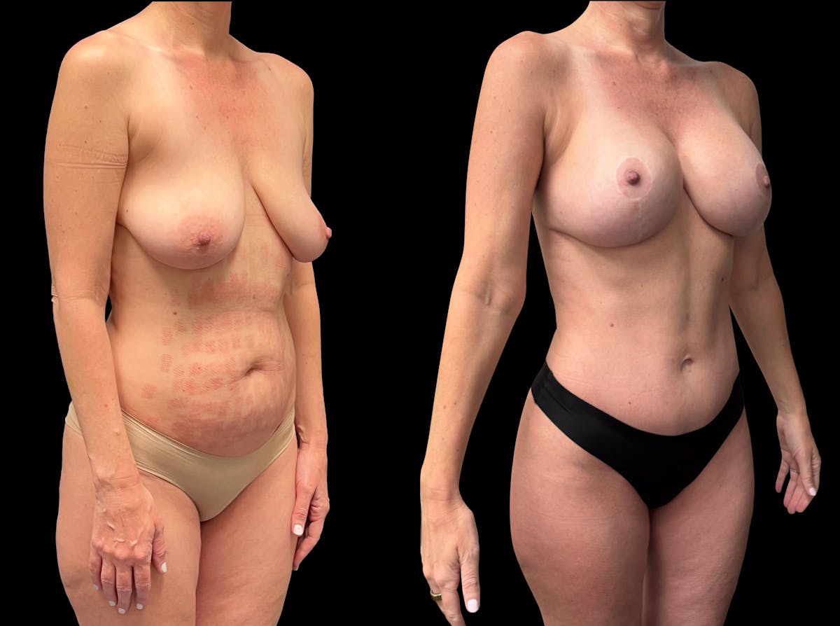 Mommy Makeover Before & After Gallery - Patient 411663 - Image 1