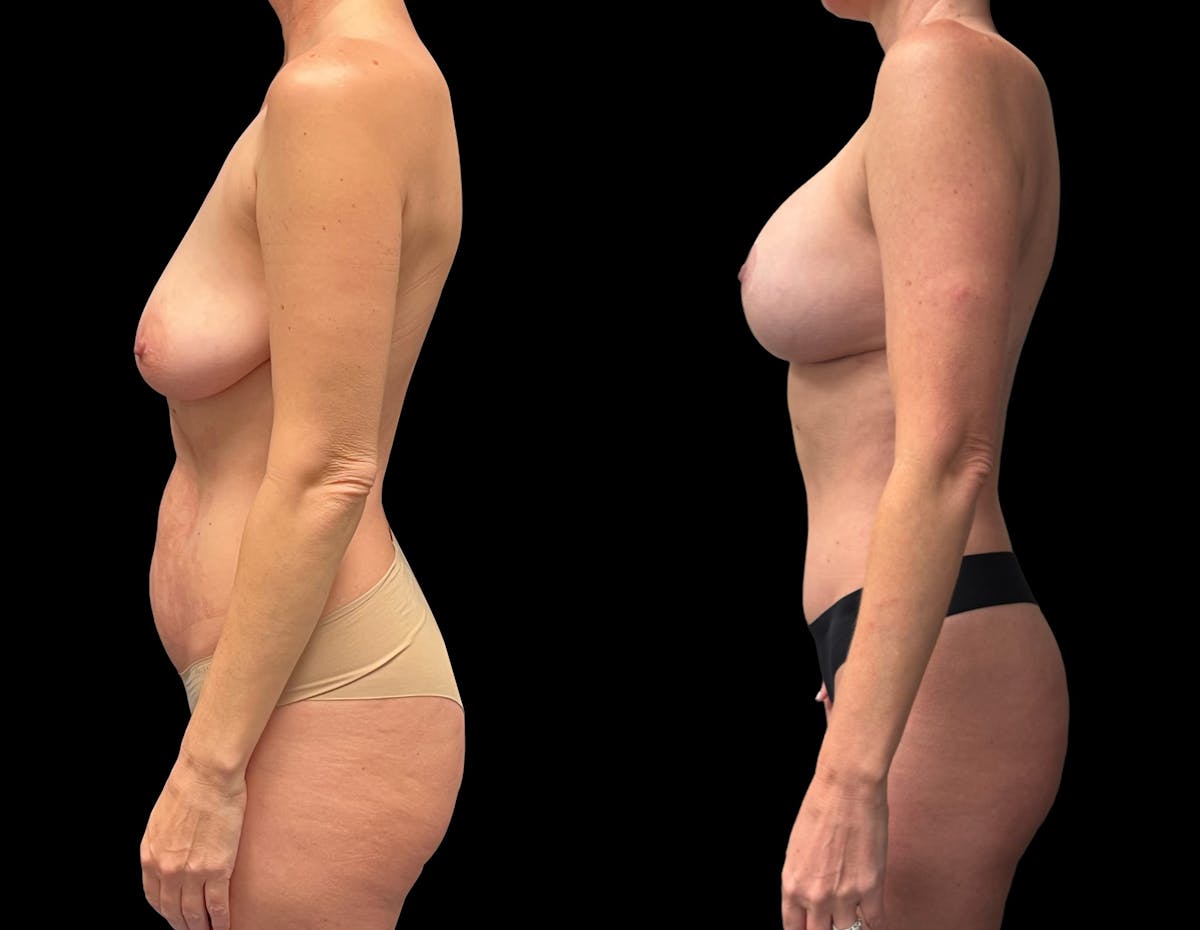 Mommy Makeover Before & After Gallery - Patient 411663 - Image 3