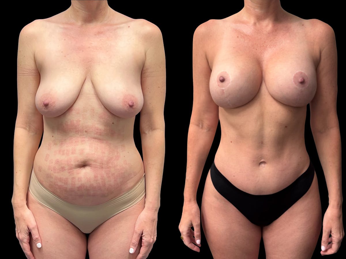 Mommy Makeover Before & After Gallery - Patient 411663 - Image 4