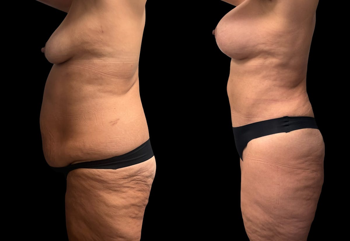 Mommy Makeover Before & After Gallery - Patient 146064 - Image 3