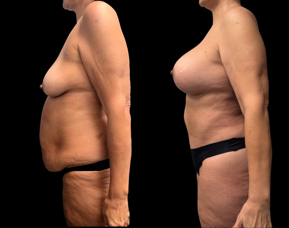 Mommy Makeover Before & After Gallery - Patient 146064 - Image 2