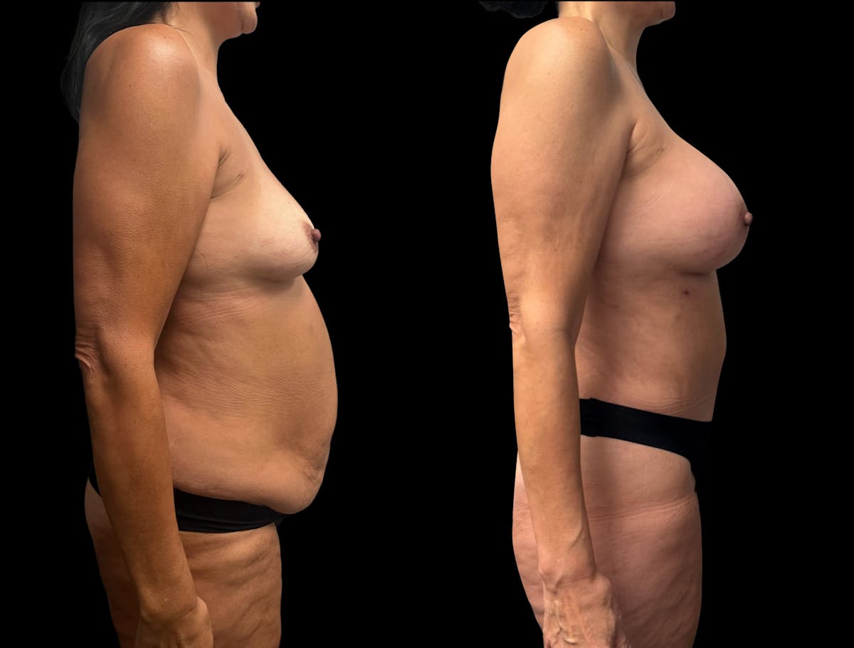 Mommy Makeover Before & After Gallery - Patient 146064 - Image 4