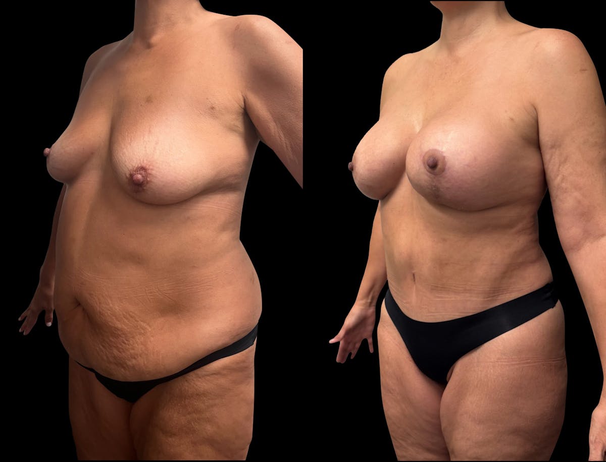 Mommy Makeover Before & After Gallery - Patient 146064 - Image 1