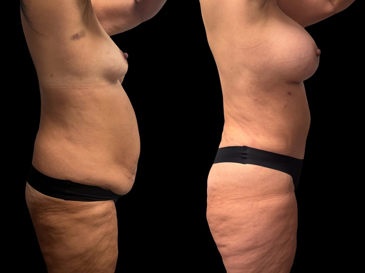 Mommy Makeover Before & After Gallery - Patient 146064 - Image 5