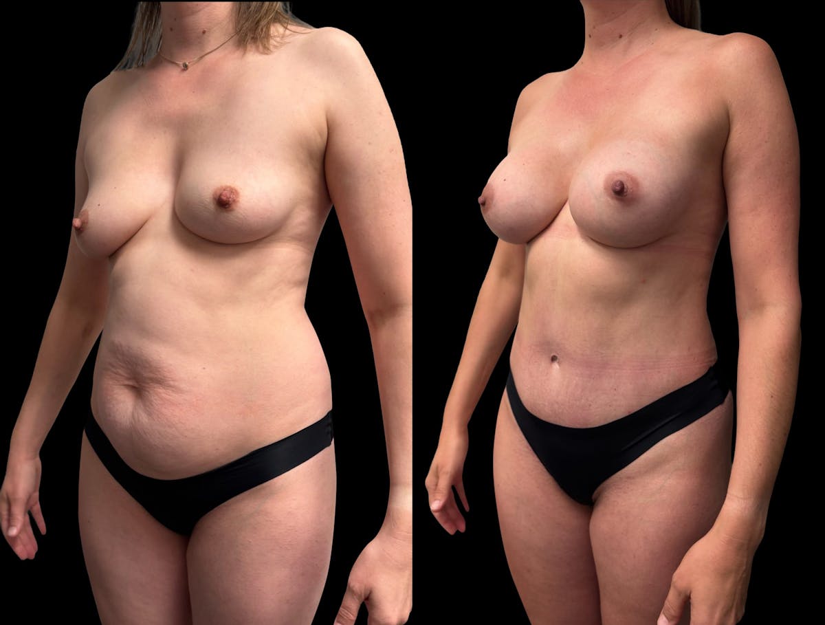 Mommy Makeover Before & After Gallery - Patient 468500 - Image 1