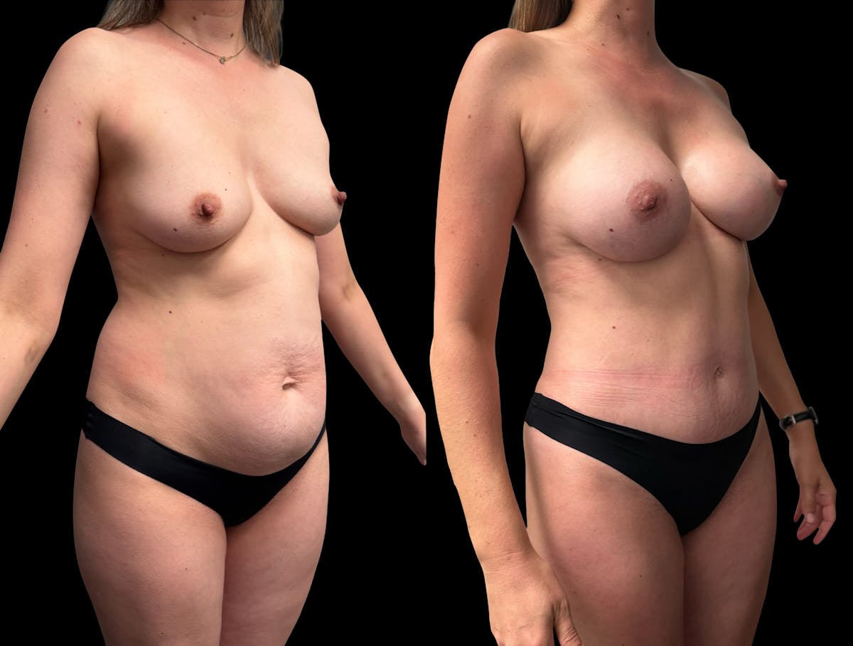 Mommy Makeover Before & After Gallery - Patient 468500 - Image 4