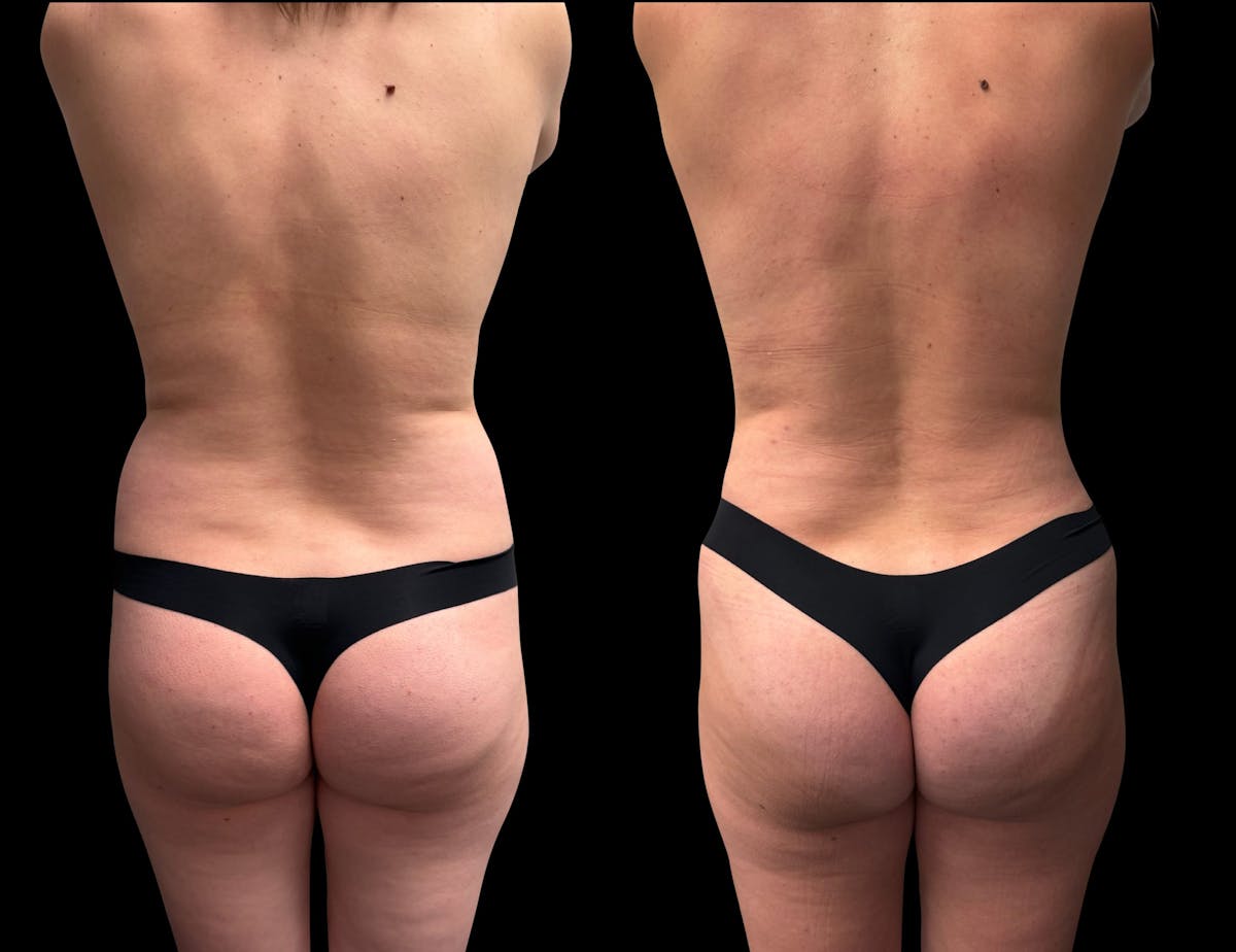 Mommy Makeover Before & After Gallery - Patient 468500 - Image 5