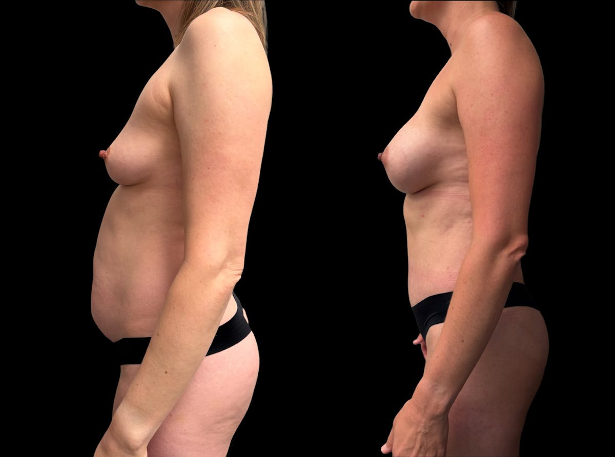 Mommy Makeover Before & After Gallery - Patient 468500 - Image 2