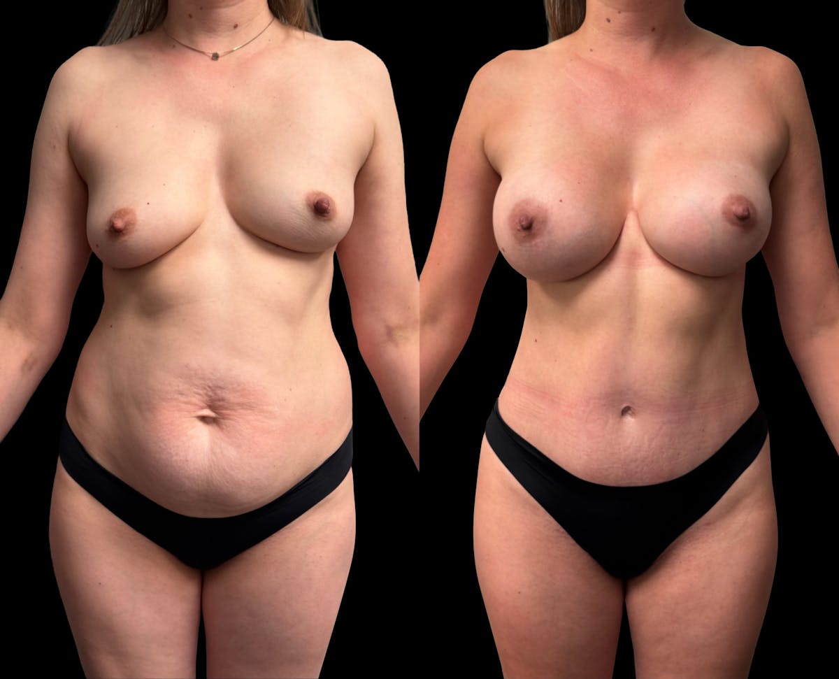 Mommy Makeover Before & After Gallery - Patient 468500 - Image 3