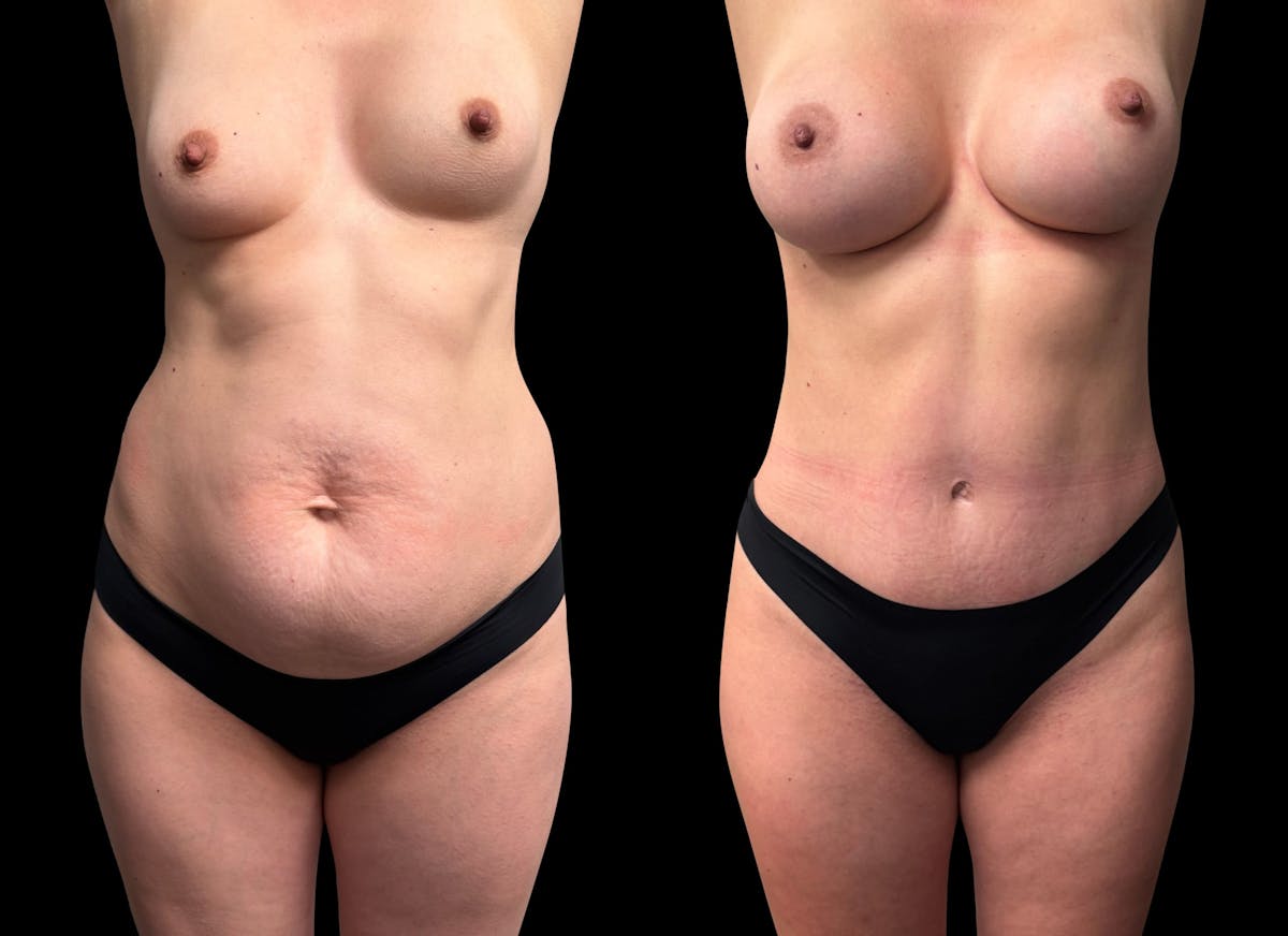 Mommy Makeover Before & After Gallery - Patient 468500 - Image 6