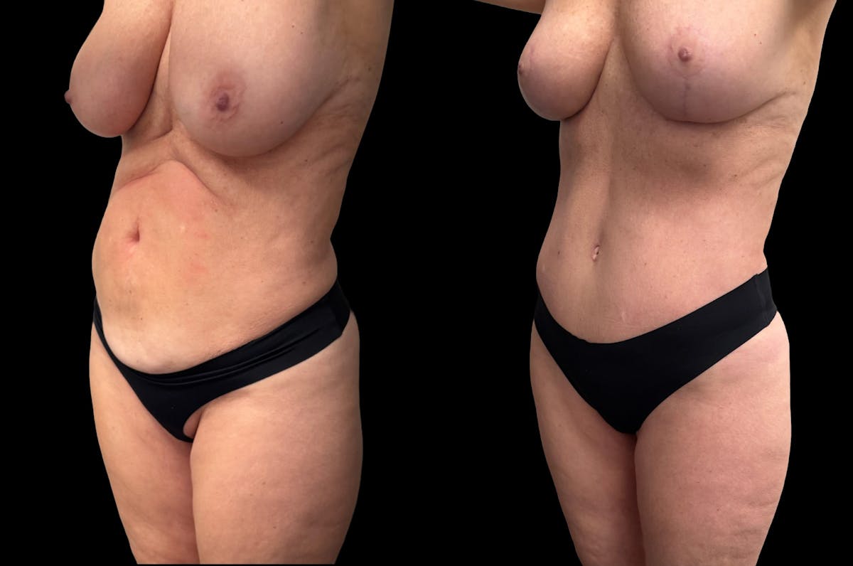 Mommy Makeover Before & After Gallery - Patient 238943 - Image 2