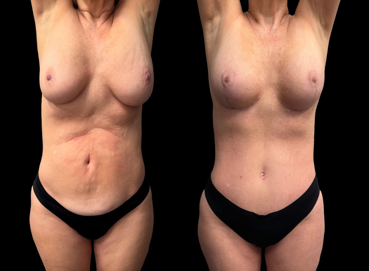 Mommy Makeover Before & After Gallery - Patient 238943 - Image 5