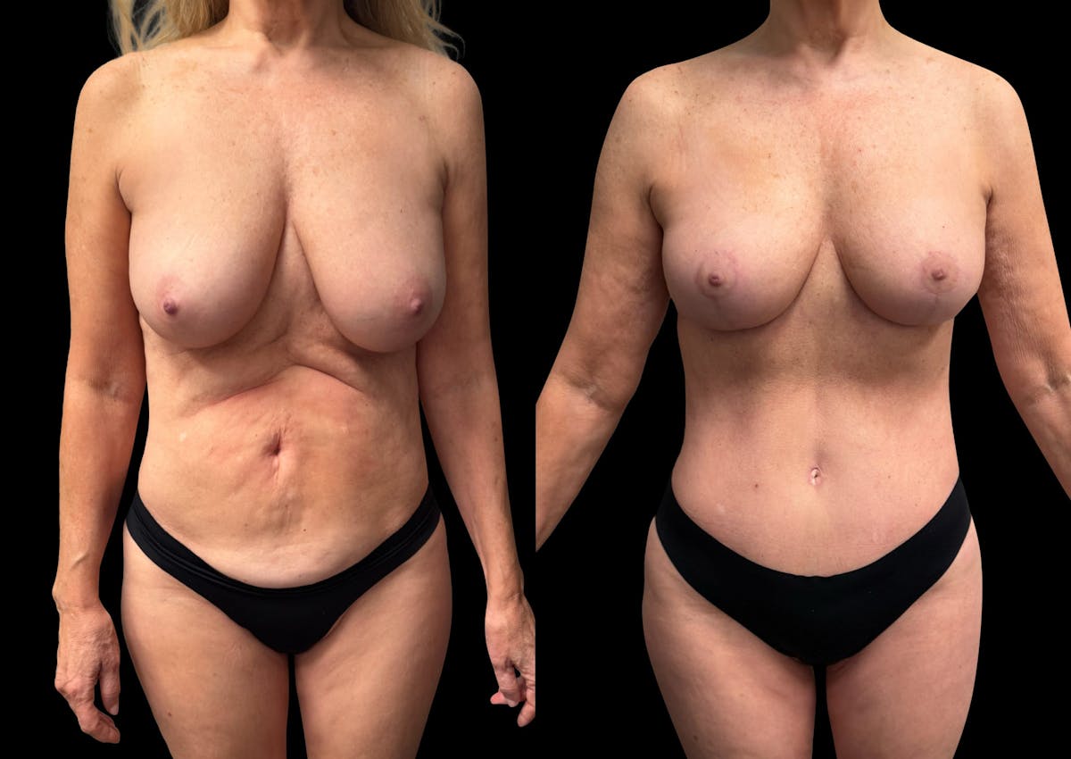 Mommy Makeover Before & After Gallery - Patient 238943 - Image 6