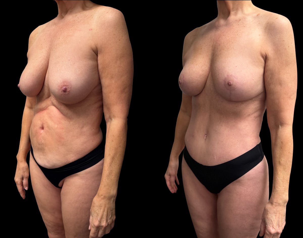 Mommy Makeover Before & After Gallery - Patient 238943 - Image 1