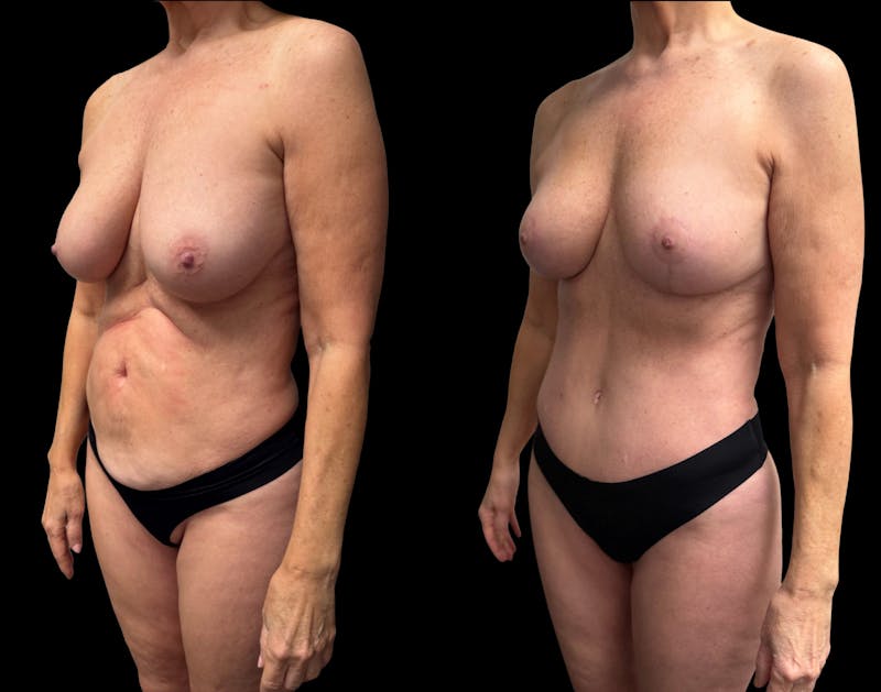 Mommy Makeover Before & After Gallery - Patient 238943 - Image 1
