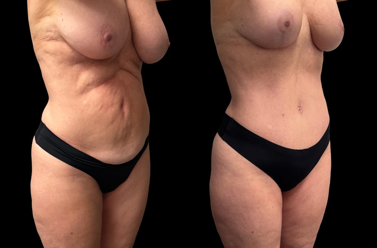 Mommy Makeover Before & After Gallery - Patient 238943 - Image 8