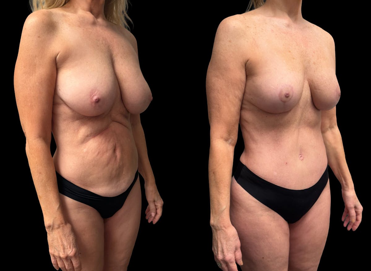 Mommy Makeover Before & After Gallery - Patient 238943 - Image 7