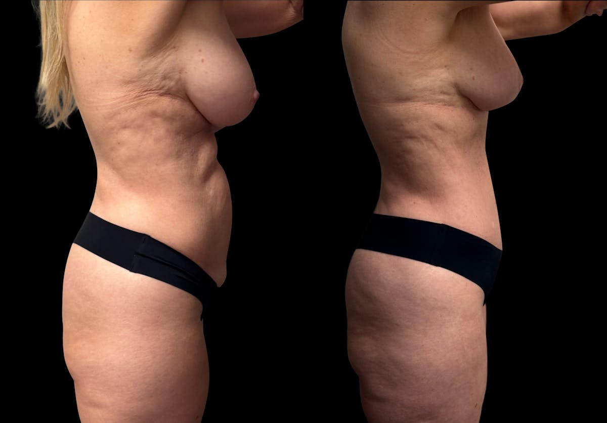 Mommy Makeover Before & After Gallery - Patient 238943 - Image 9