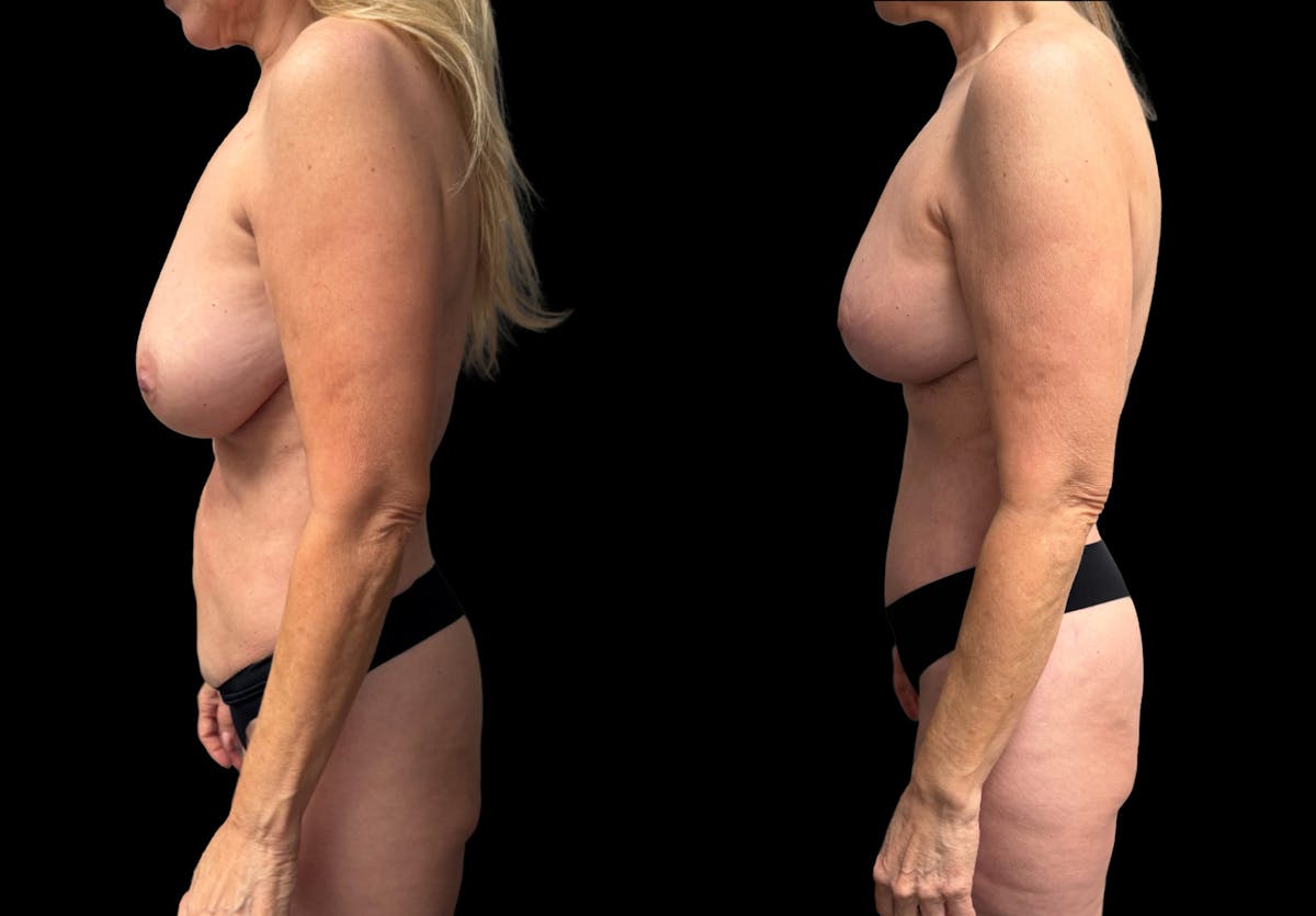 Mommy Makeover Before & After Gallery - Patient 238943 - Image 4