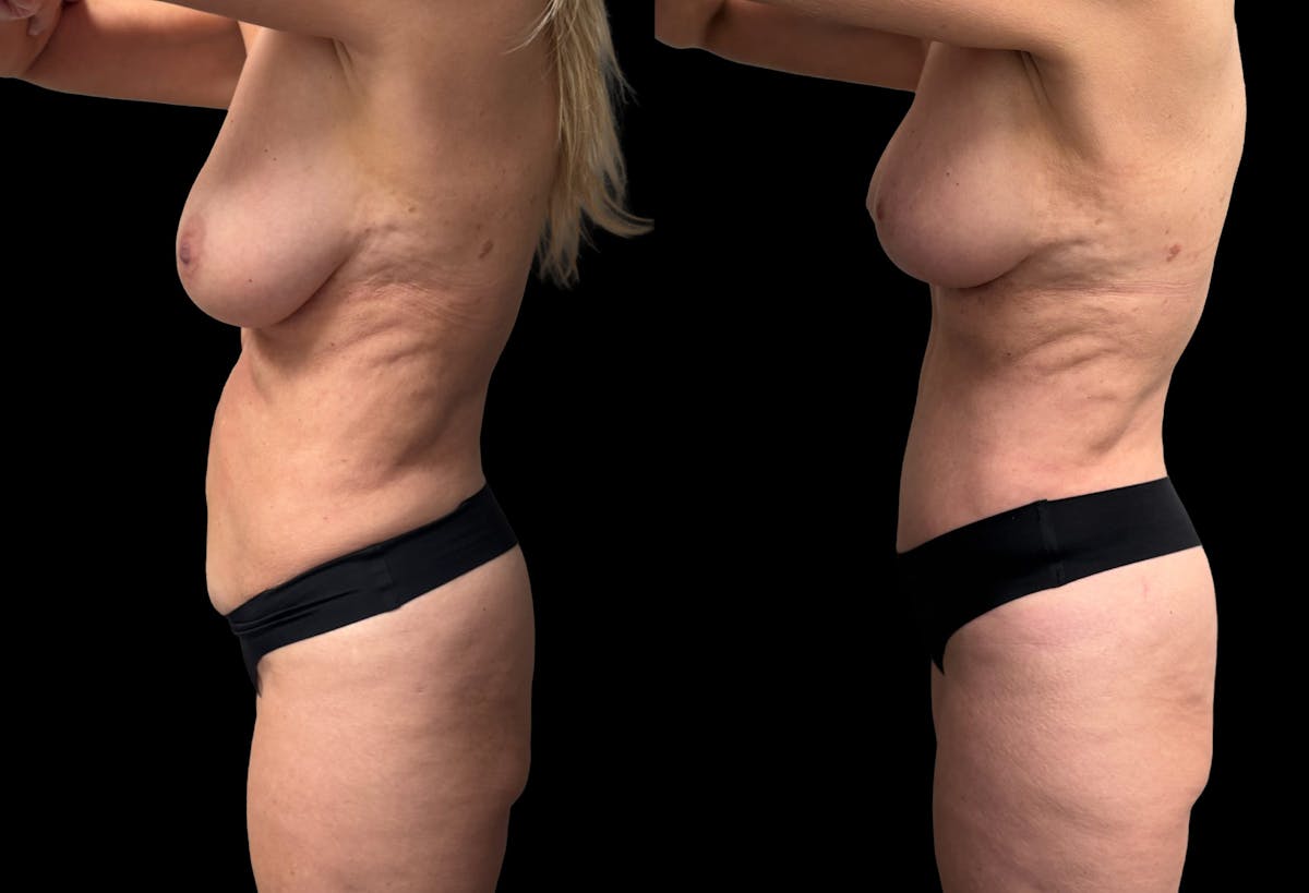 Mommy Makeover Before & After Gallery - Patient 238943 - Image 3