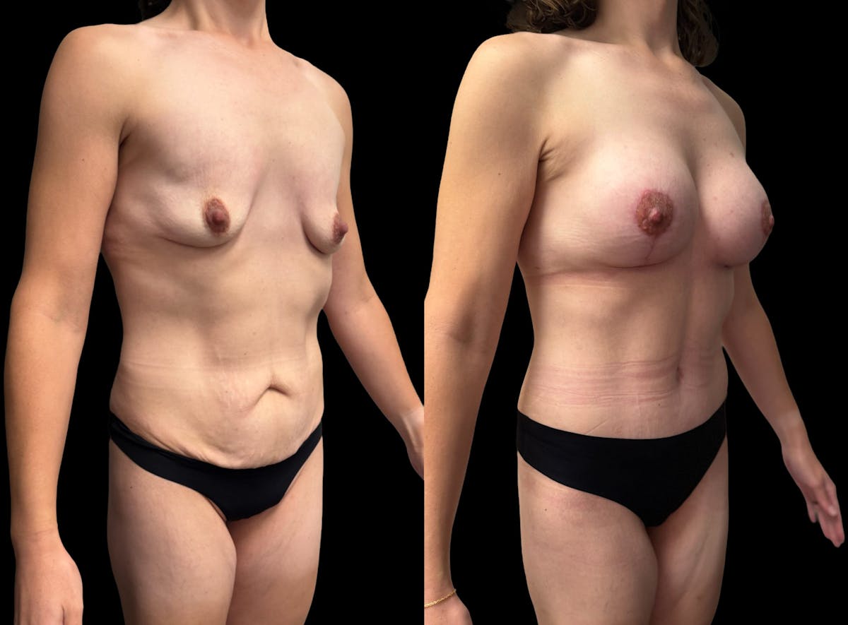 Mommy Makeover Before & After Gallery - Patient 415408 - Image 4