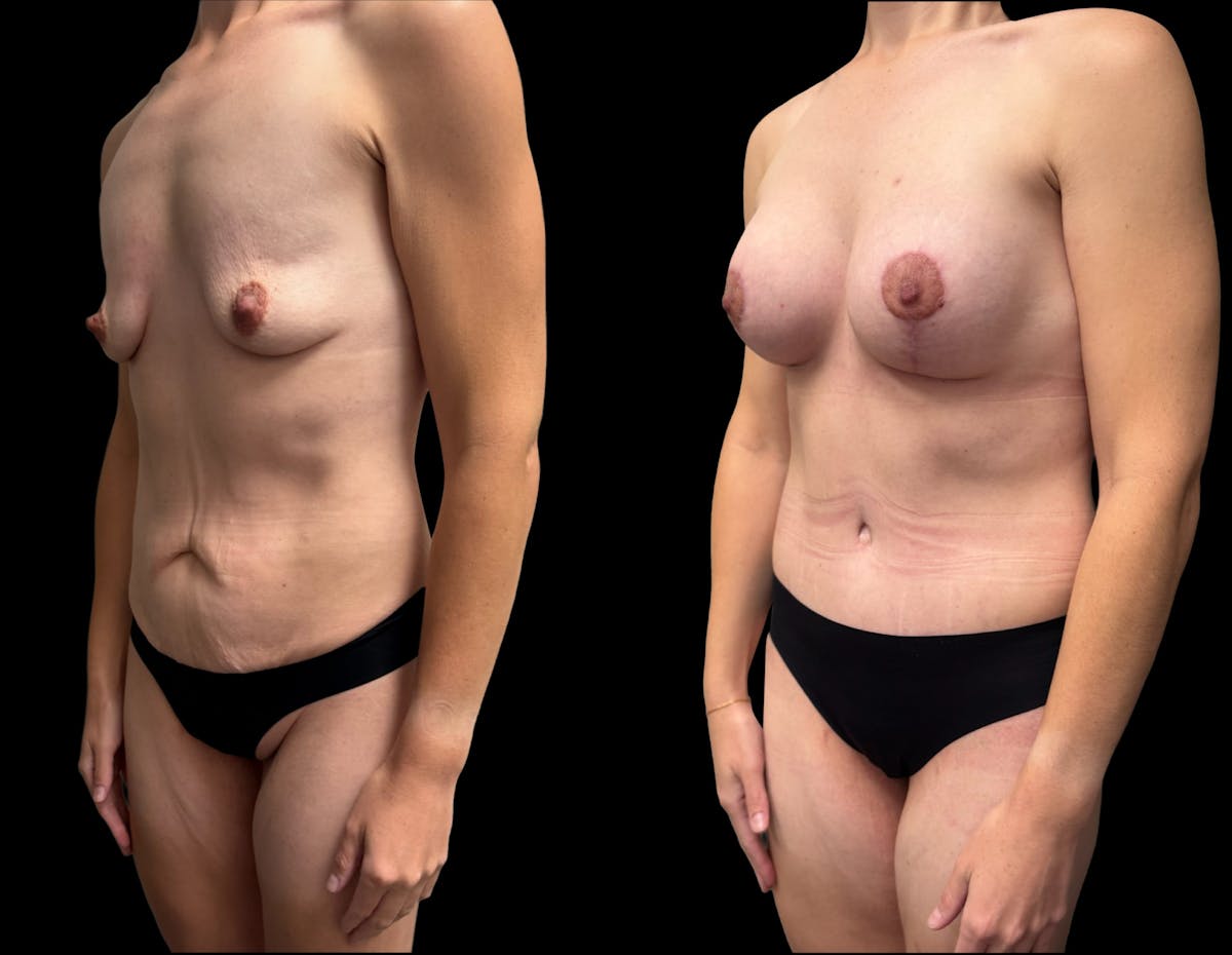 Mommy Makeover Before & After Gallery - Patient 415408 - Image 1