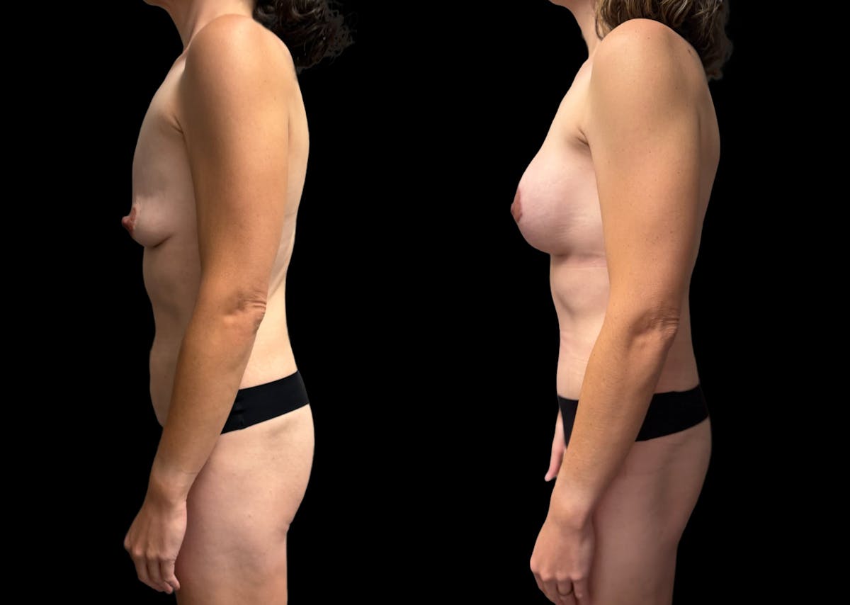 Mommy Makeover Before & After Gallery - Patient 415408 - Image 2