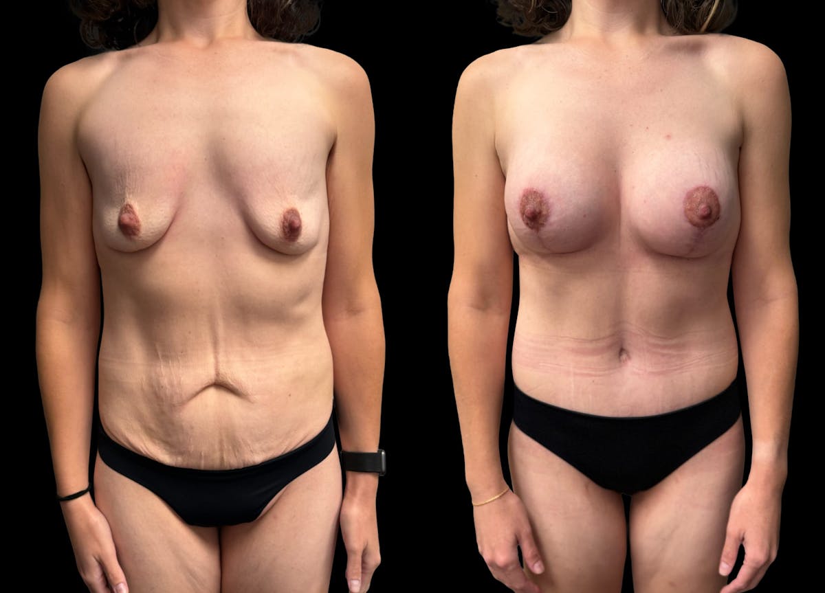 Mommy Makeover Before & After Gallery - Patient 415408 - Image 3