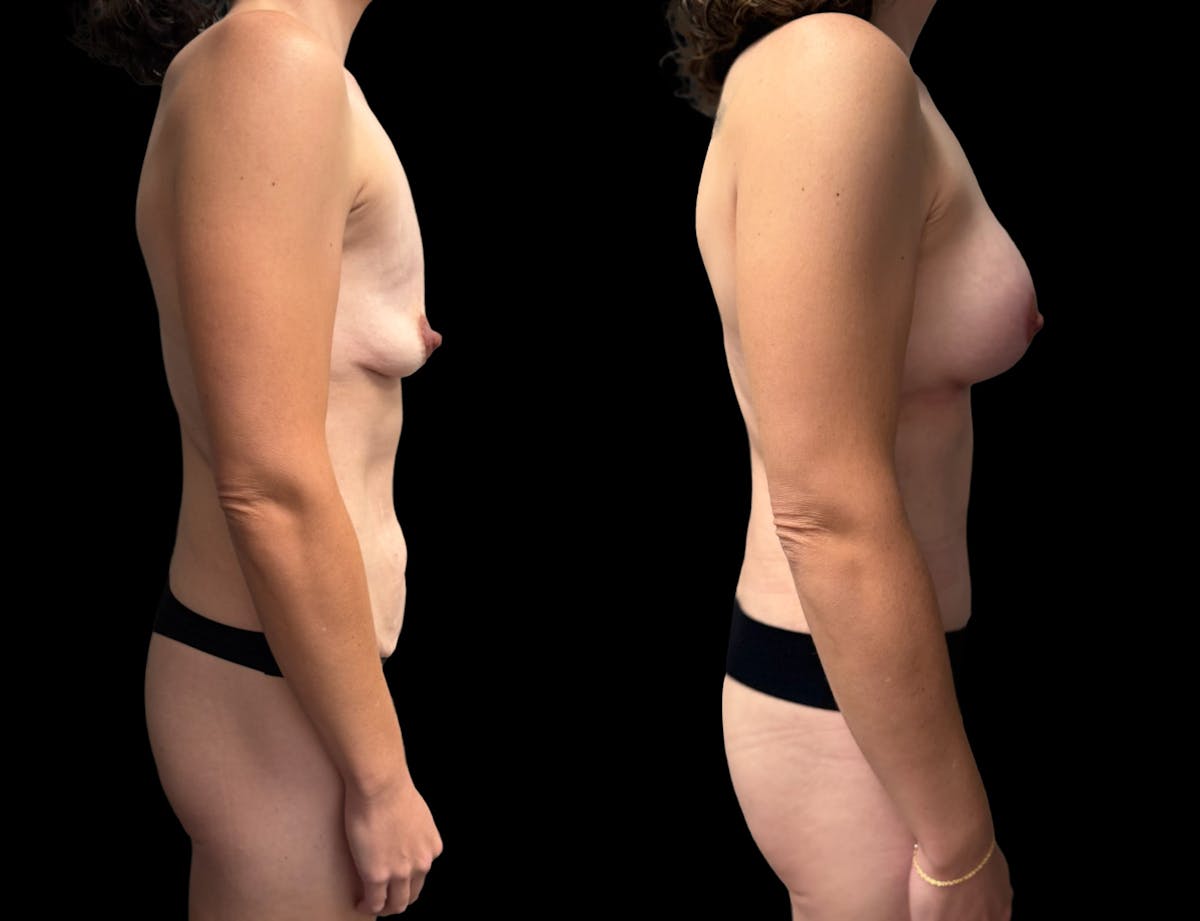 Mommy Makeover Before & After Gallery - Patient 415408 - Image 5