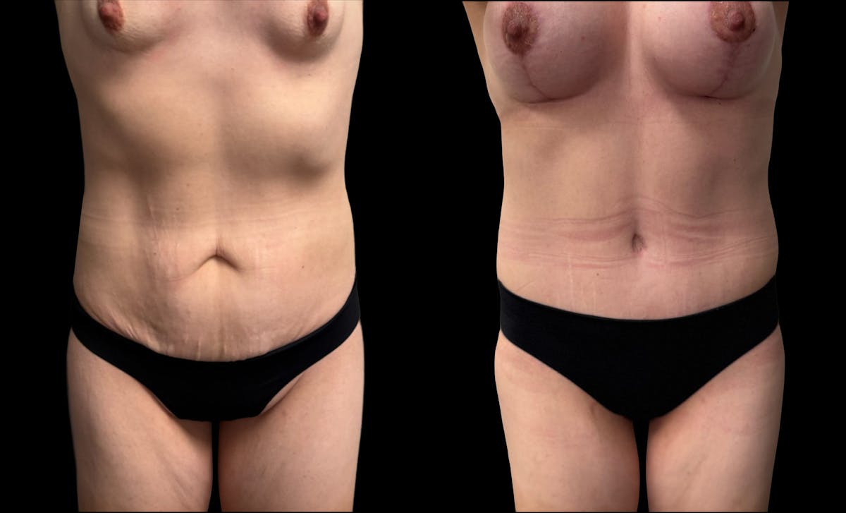 Mommy Makeover Before & After Gallery - Patient 415408 - Image 6