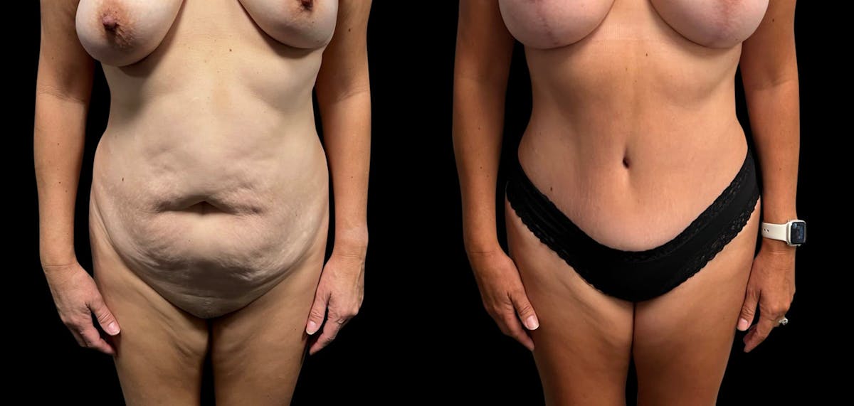 Tummy Tuck Before & After Gallery - Patient 322332 - Image 1
