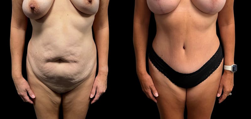Tummy Tuck Before & After Gallery - Patient 322332 - Image 1
