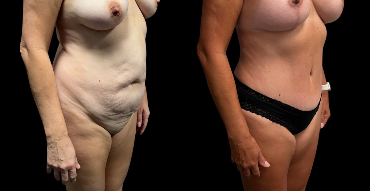 Tummy Tuck Before & After Gallery - Patient 322332 - Image 4