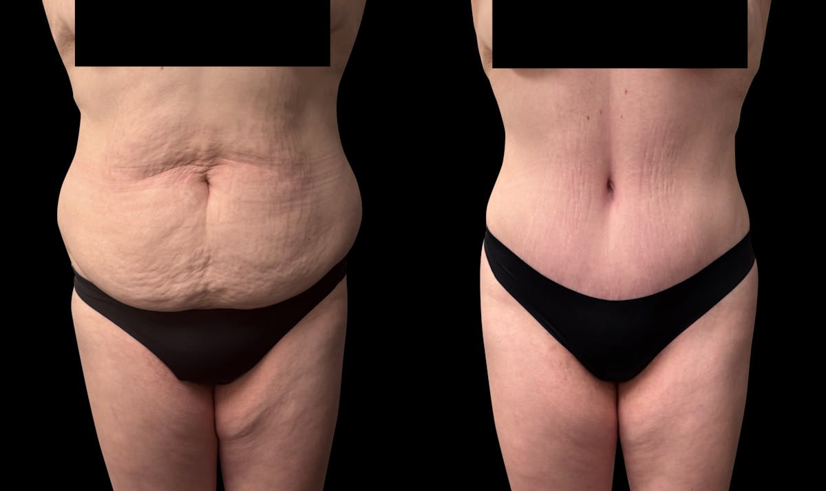 Tummy Tuck Before & After Gallery - Patient 764113 - Image 2