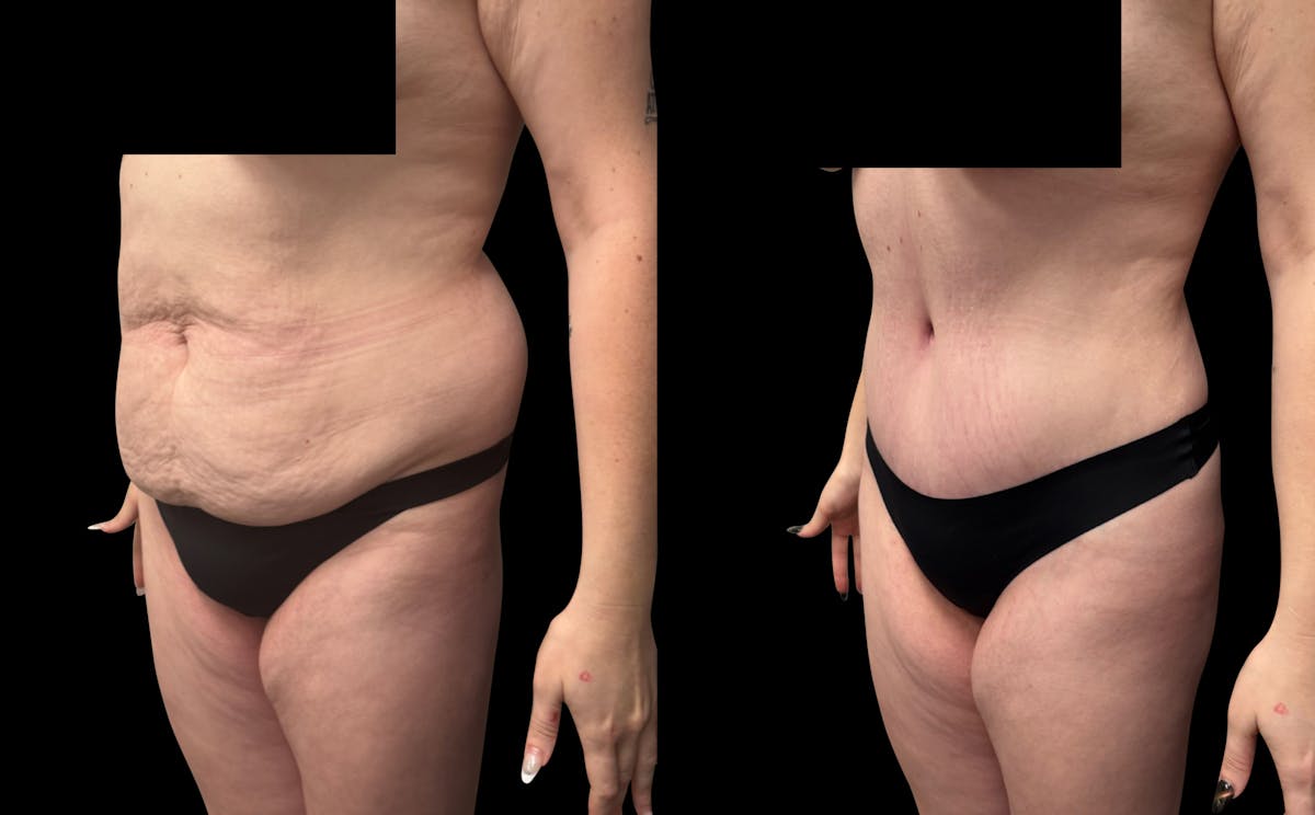 Tummy Tuck Before & After Gallery - Patient 764113 - Image 3