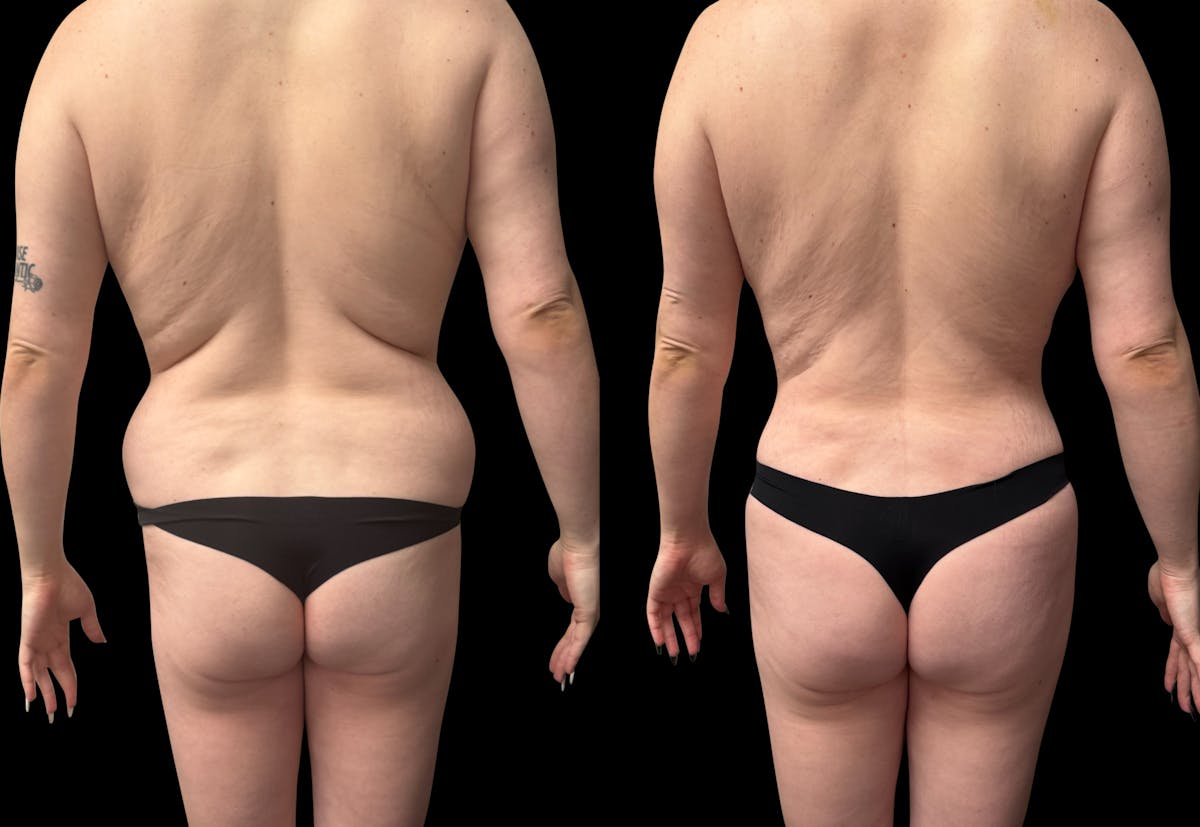 Tummy Tuck Before & After Gallery - Patient 764113 - Image 6