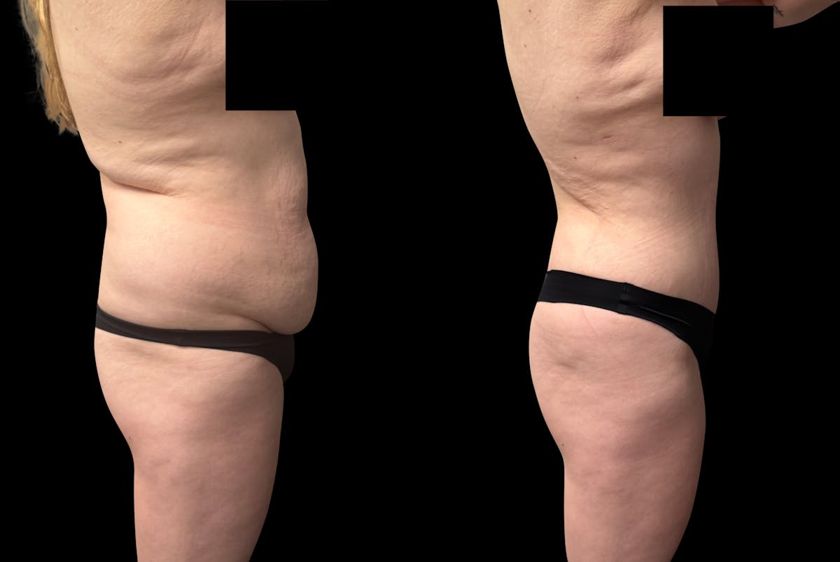 Tummy Tuck Before & After Gallery - Patient 764113 - Image 4