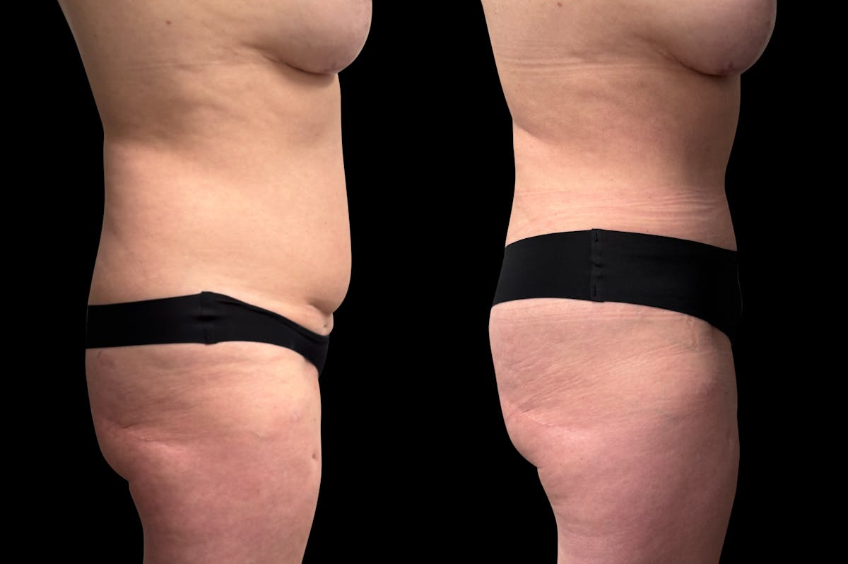 Tummy Tuck Before & After Gallery - Patient 415668 - Image 6