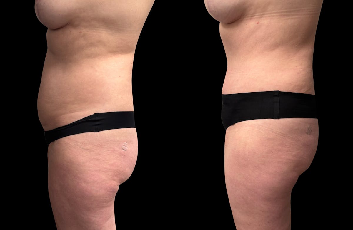 Tummy Tuck Before & After Gallery - Patient 415668 - Image 4