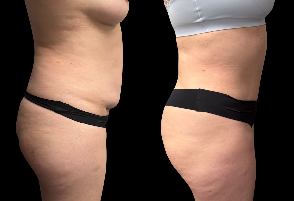 Tummy Tuck Before & After Gallery - Patient 337273 - Image 6