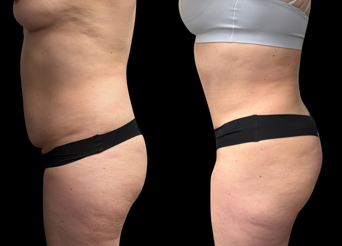 Tummy Tuck Before & After Gallery - Patient 337273 - Image 4